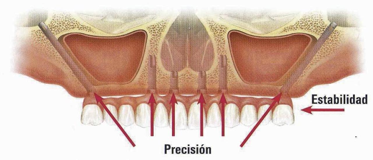 Reproducción de un implante zigomático que se coloca en la dentadura superior .  // FdV