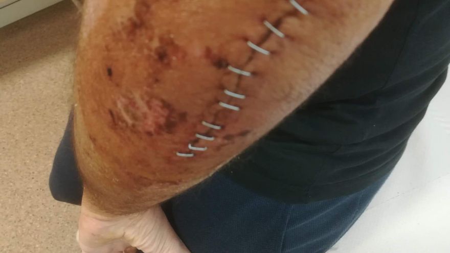Se cae de la bici en un camino de Monforte, se destroza el codo y tiene que pagar 800 euros