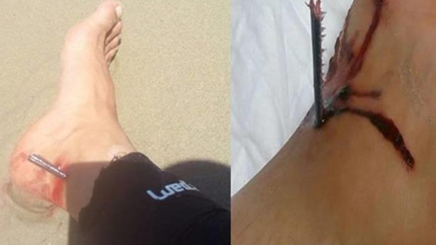 Un pez aguja hiere en Cabo Roig a un kitesurfista