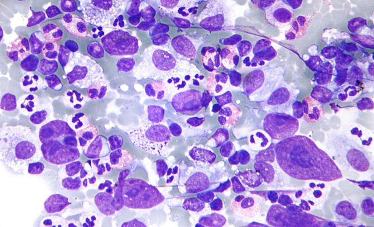 Micrograph of Hodgkin lymphoma, abbreviated HL. Lymph node FNA specimen