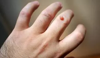 ¿Son hereditarias y contagiosas las verrugas?