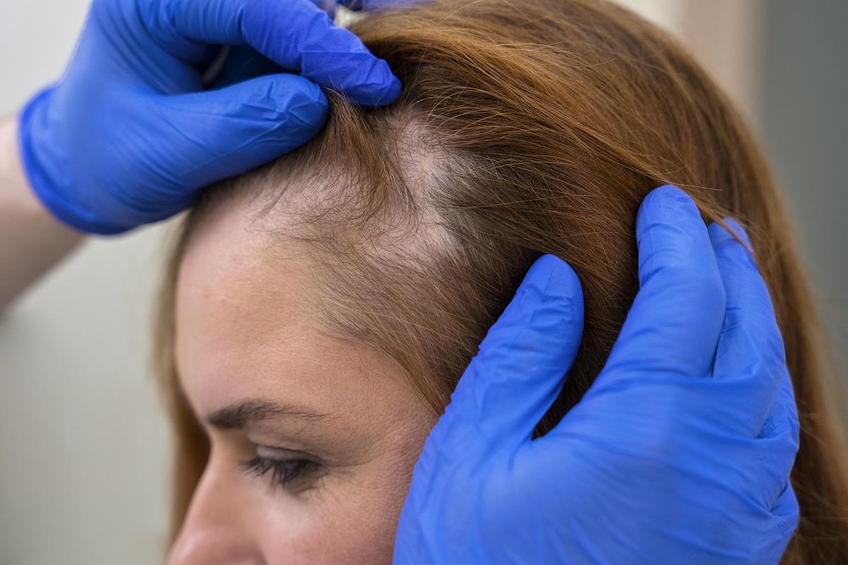 Algunas patologías reumáticas provocan alopecia.