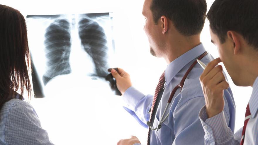 El cáncer de pulmón causa 20.000 muertes cada año en España.
