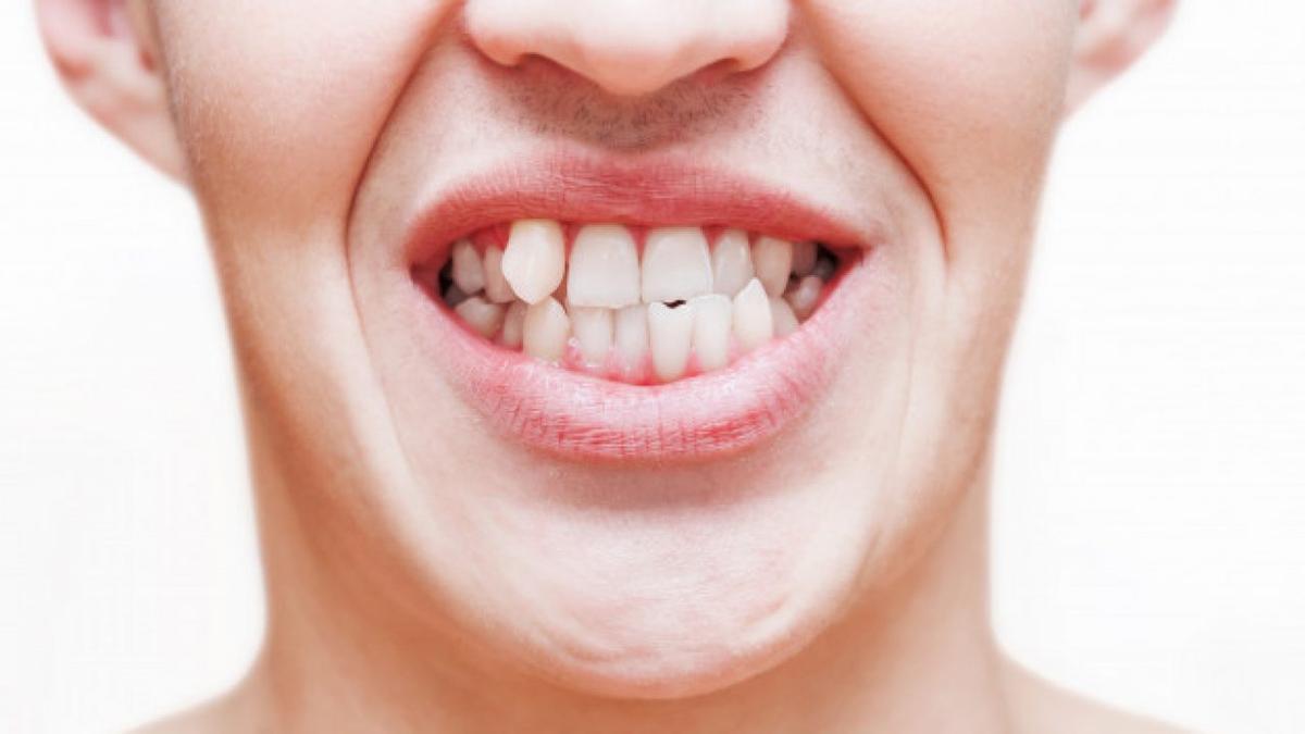 ¿Cuáles son las principales causas de los dientes torcidos?