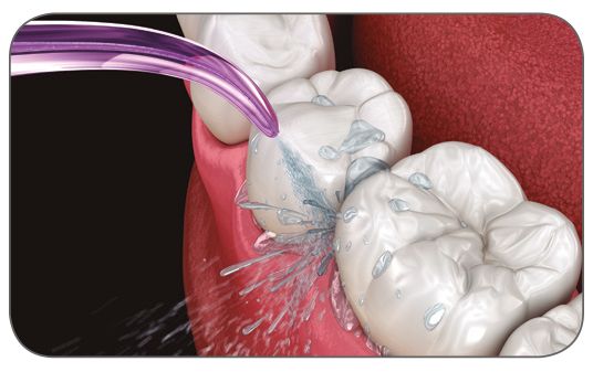 Es preciso recalcar que el irrigador dental no sustituye ni al cepillo de dientes, ni a los instrumentos interdentales, ni al enjuague bucal.