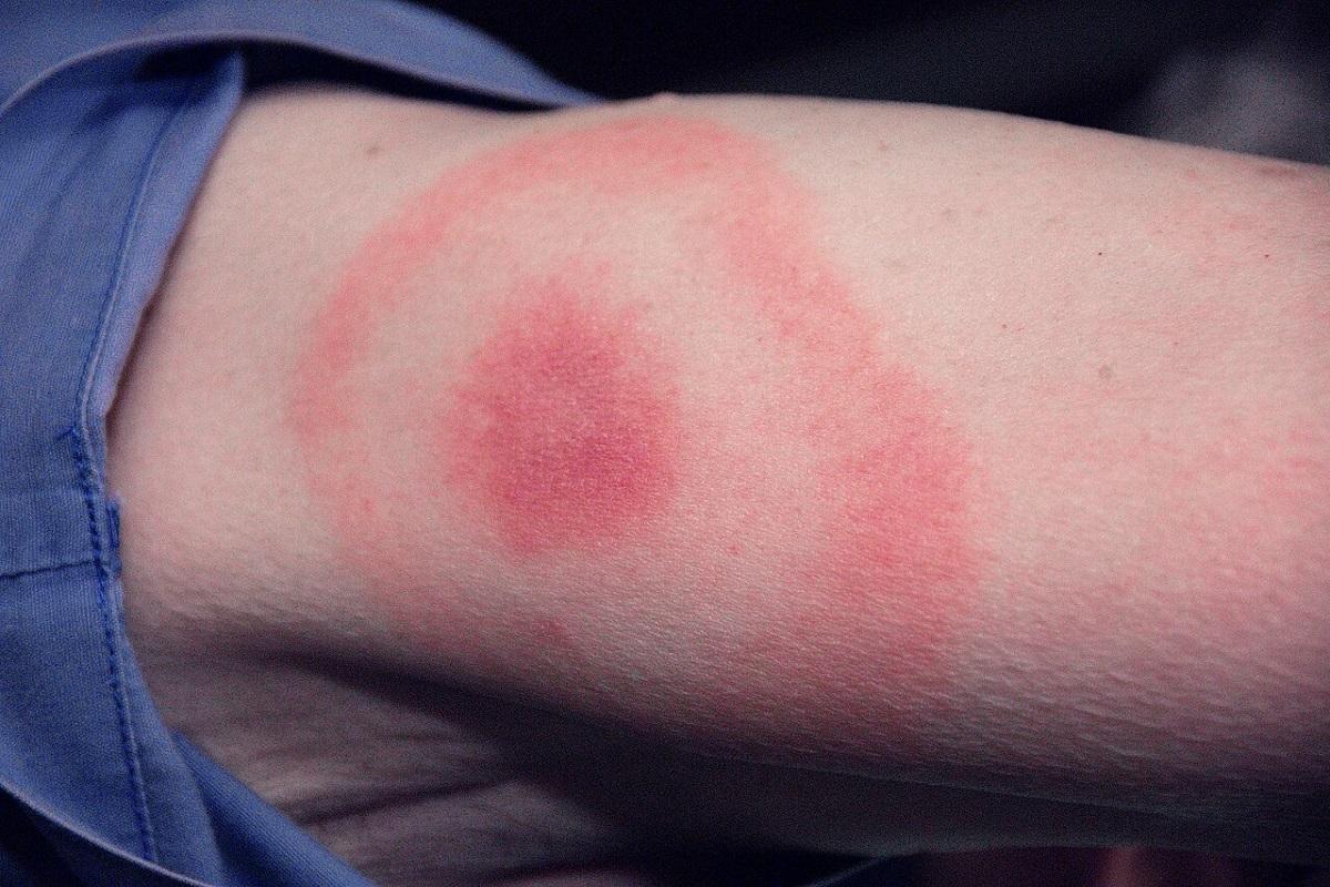 La enfermedad de Lyme es una infección bacteriana provocada por la picadura de garrpata.