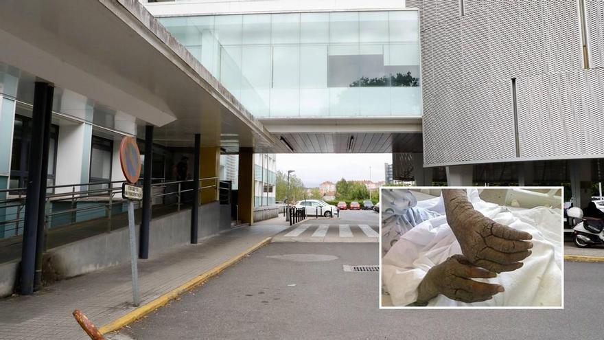 Un brote de sarna noruega afecta a al menos una veintena de trabajadores sanitarios del Hospital Provincial de Conxo