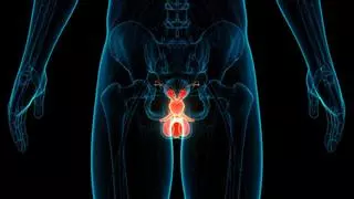 Cómo descubrir que la próstata se está haciendo grande y cómo aliviar los síntomas