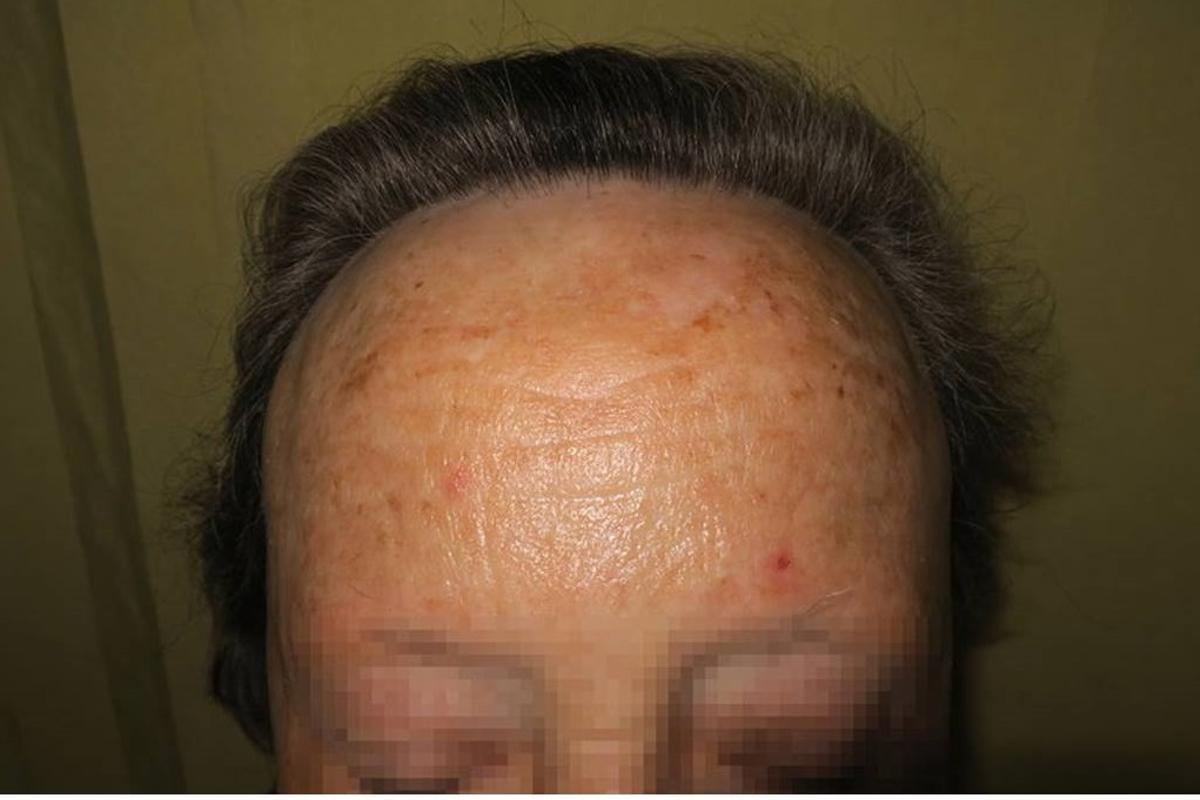 Una mujer con alopecia frontal fibrosante.