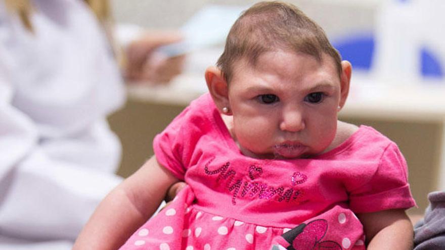Un bebé afectado por microcefalia en Brasil.