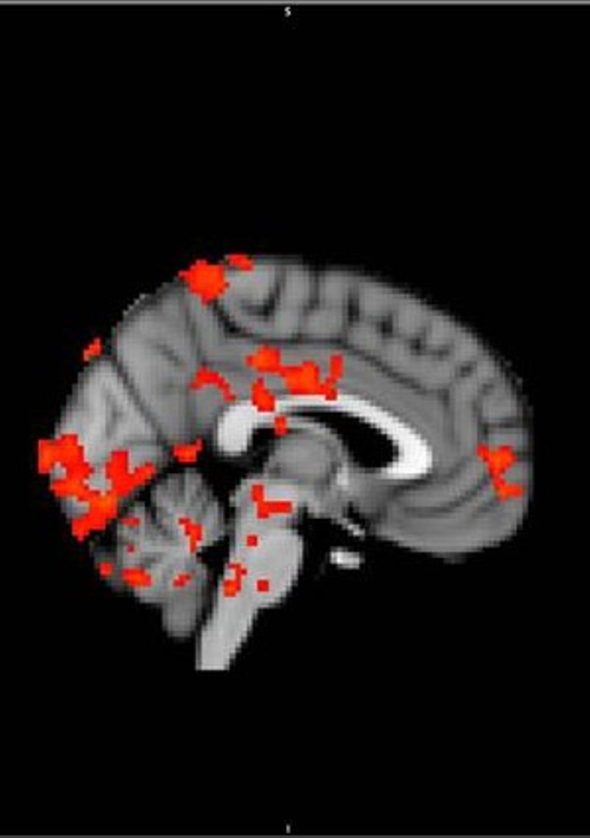 El cervell del bioquímic Pere Estupinyà tenint un orgasme. El cervell del bioquímic Pere Estupinyà tenint un orgasme.