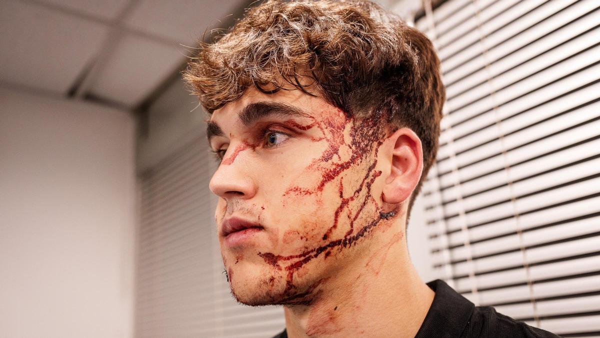 Le visage de Pau Cubarsí après le coup qu'il a reçu lors du match Étoile Rouge-Barça à Belgrade.