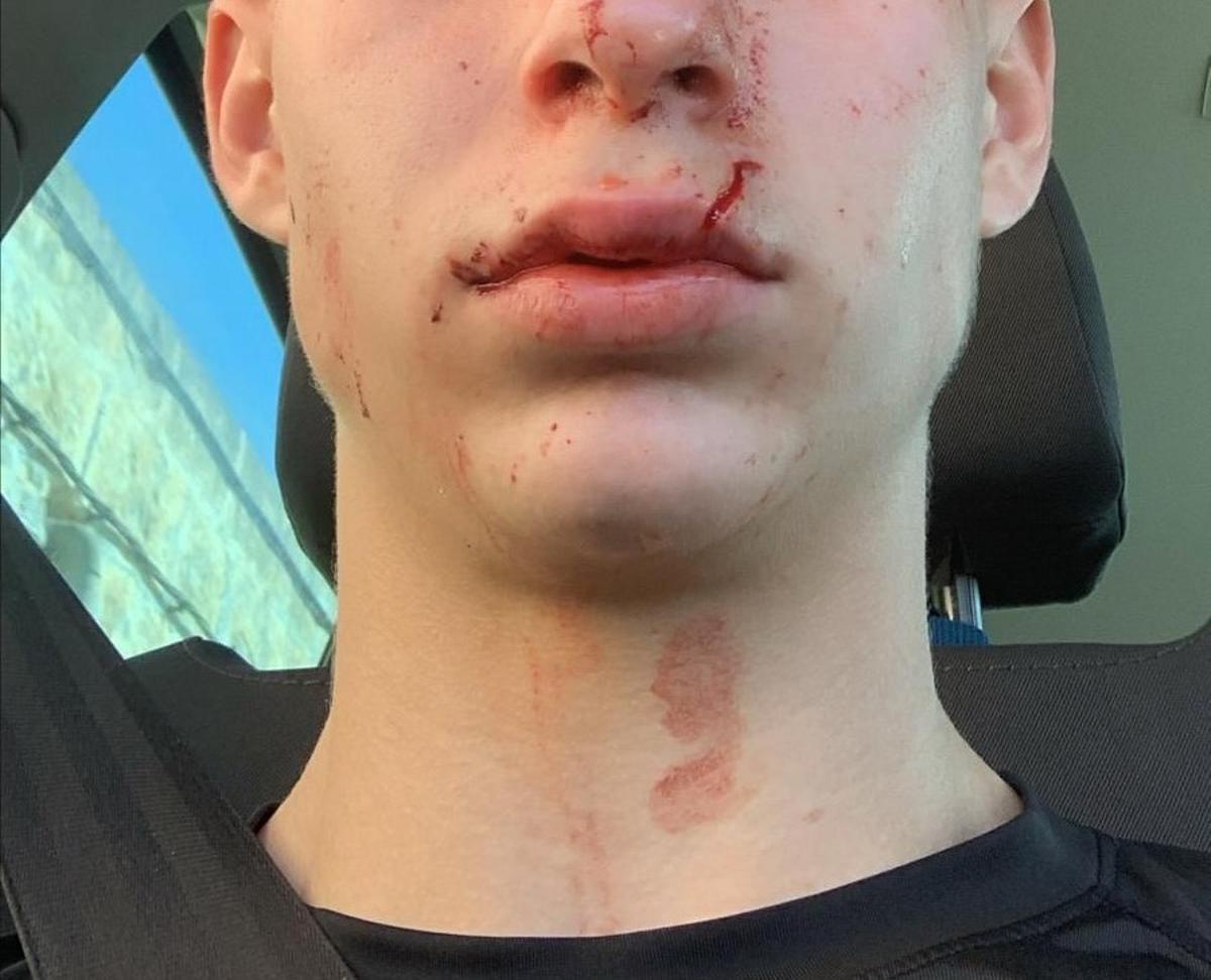 El futbolista del Sant Jordi, camino del hospital para ser atendido