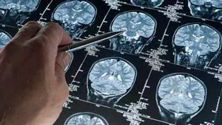 Luz verde al primer medicamento eficaz contra el Alzheimer en etapas tempranas