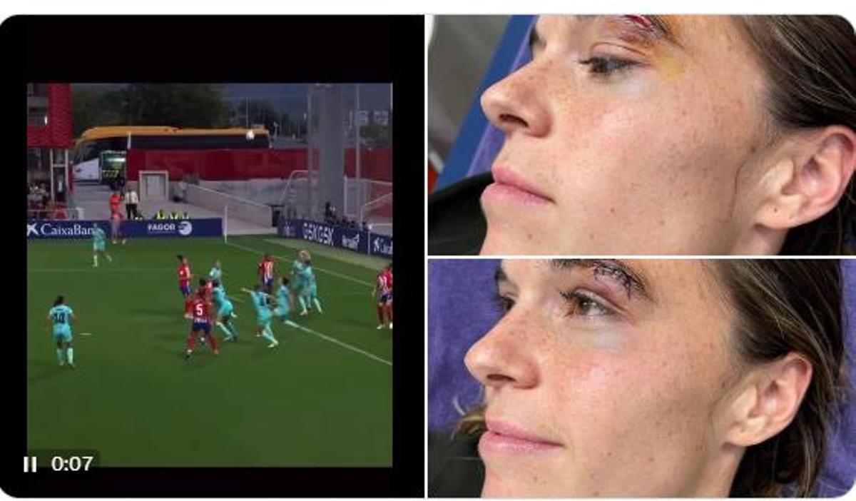 La herida de Mapi León tras el 'codazo' ante el Atlético de Madrid