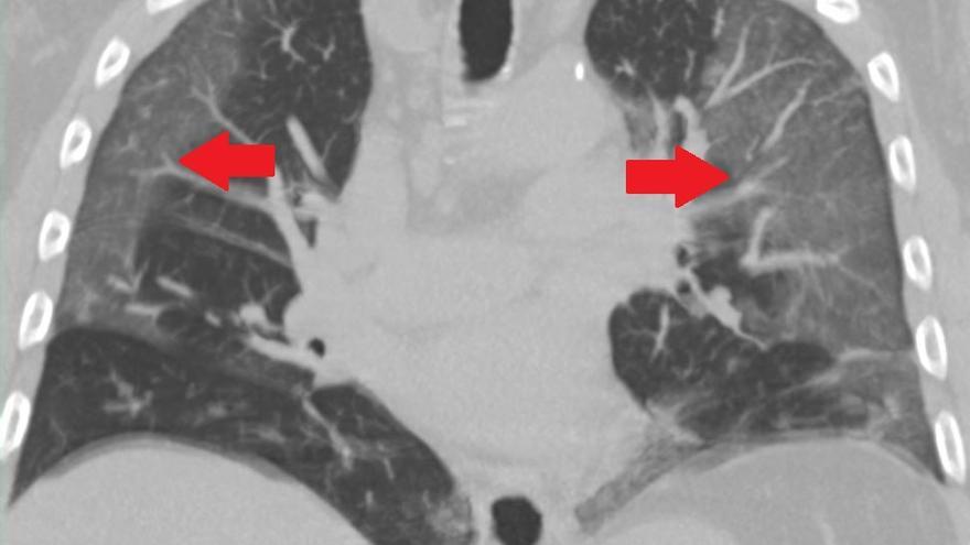 Imagen de una tomografía computarizada de un paciente con neumonía causada por COVID-19.