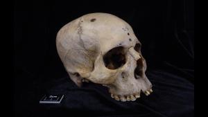 Cráneo de un individuo del antiguo Egipto con signos de haber sufrido un cáncer cerebral.