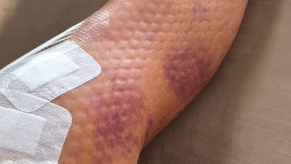 Imágenes de la rodilla de Riqui Puig