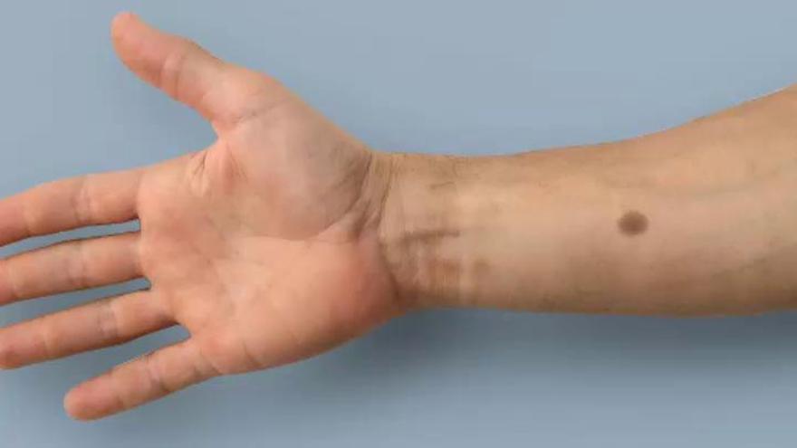 Un tatuaje biomédico que avisa de la formación de un tumor