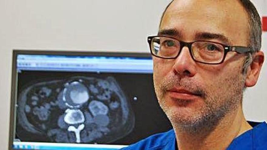 José María Roselló, cirujano vascular de Can Misses, con una prueba diagnóstica de un aneurisma de 8,46 centímetros.