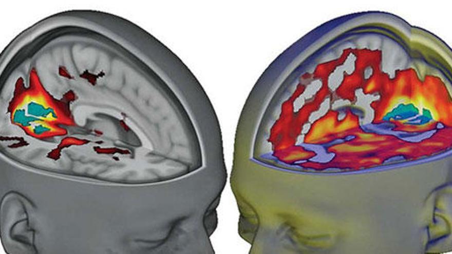 Resonancia del cerebro de una persona bajo efectos del LSD.