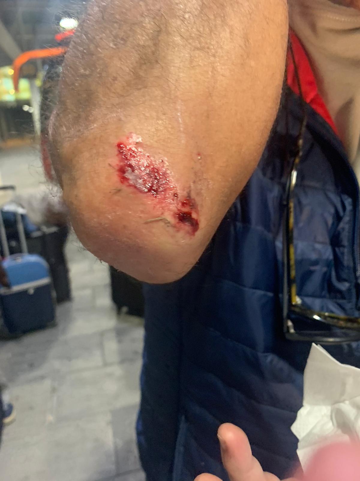 Un turista canario del Imserso muestra su herida en un codo tras ser agredido en Barcelona.