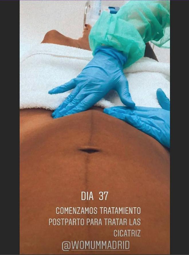 Elena Tablada en un tratamiento para la cicatriz de la cesárea