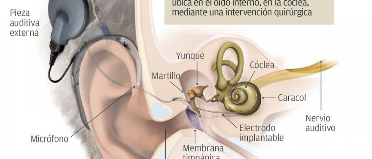 Un dispositivo que revierte la sordera