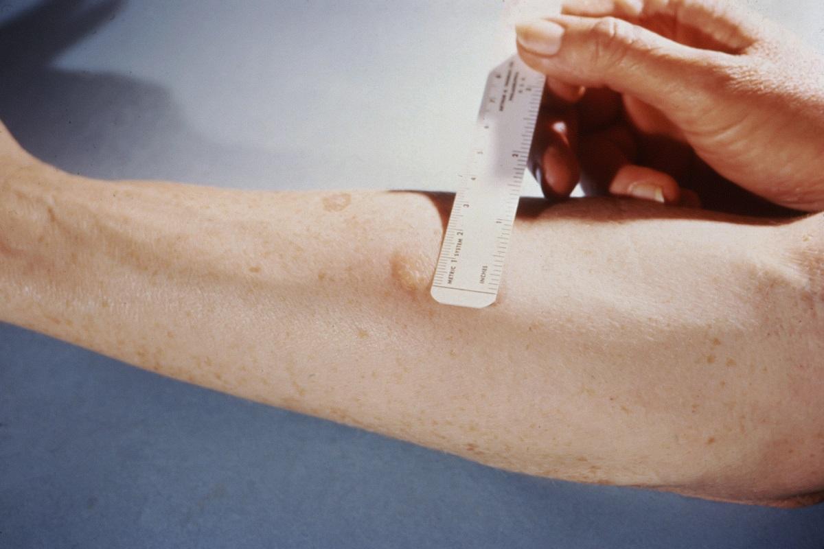 Prova de la tuberculosi.