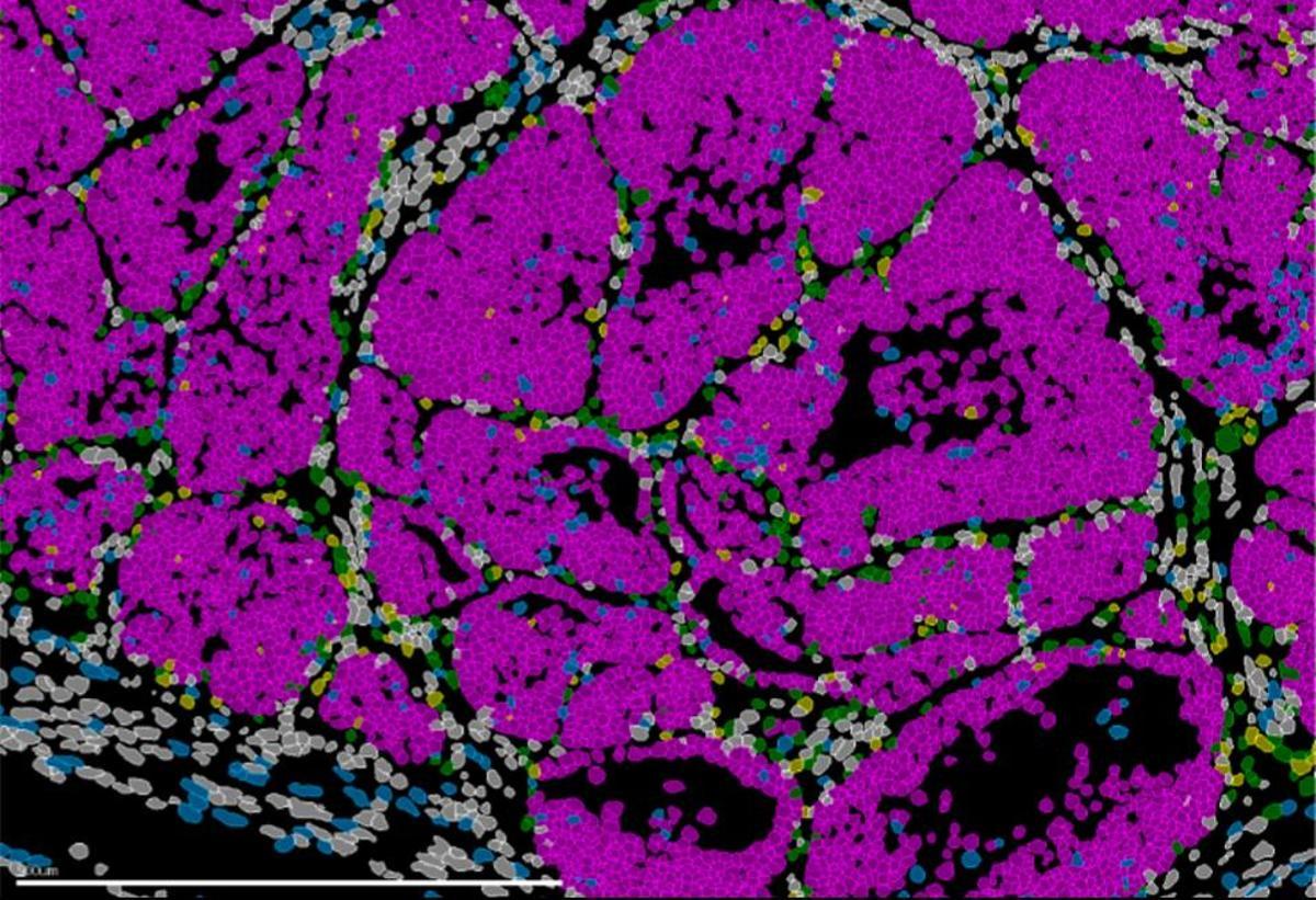Imagen de un tumor de mama en ratón que muestra las distintas poblaciones celulares (células cancerosas en rosa). Tecnologías avanzadas de biología espacial permiten la identificación simultánea de todos los tipos celulares presentes en el tejido