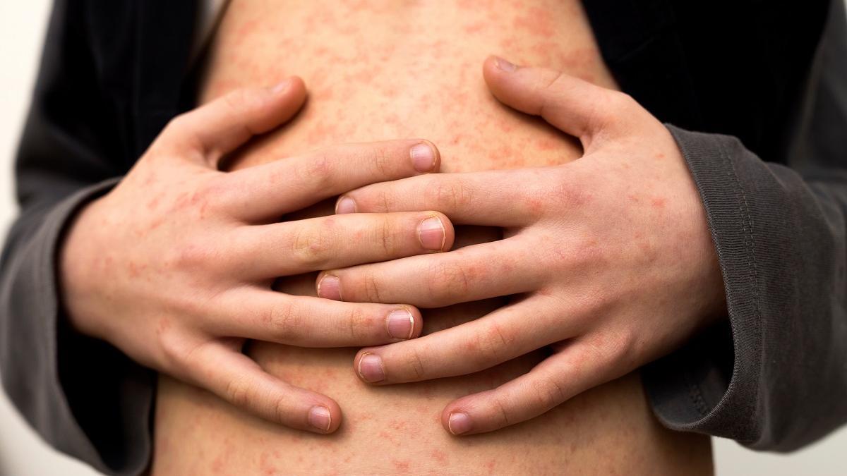Las manchas rojizas en la piel son características del sarampión.