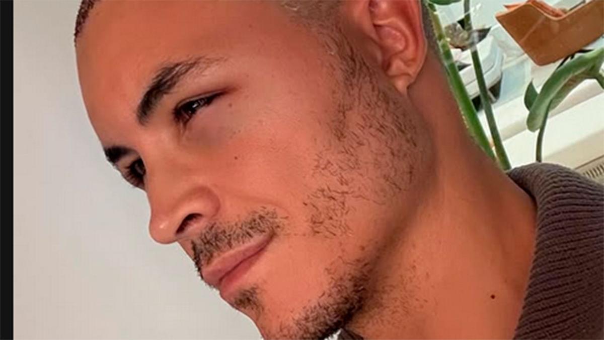 El motivo por el que Kiko Jiménez se ha tenido que hacer un injerto capilar de última hora: &quot;Por qué se opera si tenía mucho pelo&quot;