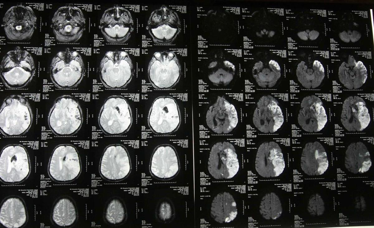 Varias radiografías del cerebro de un paciente que ha sufrido un ictus, otro de los principales motivos de decesos.