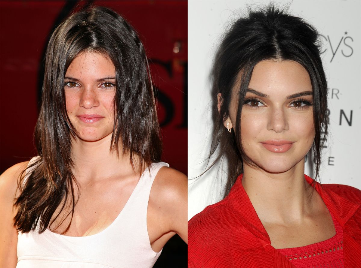 Kendall Jenner con acné