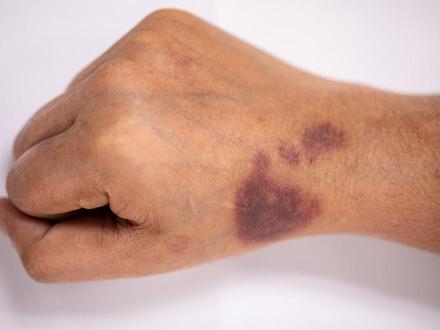 Trombocitopenia inmune: la enfermedad que empieza con hematomas y nos puede dejar sin ...