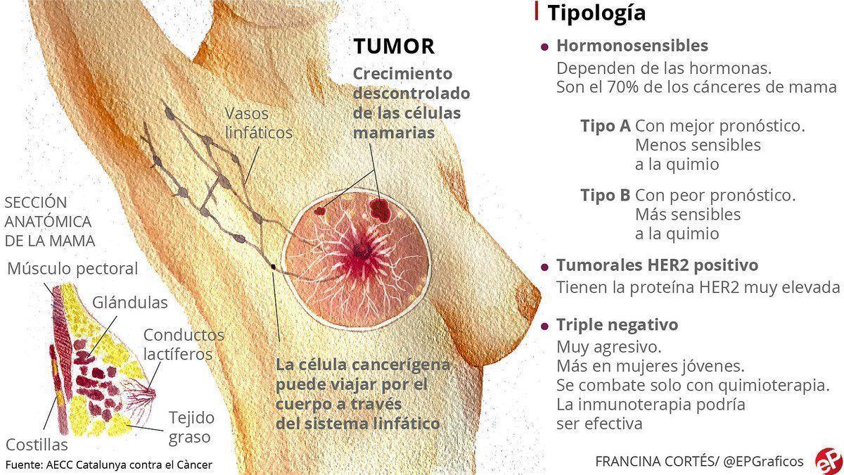 Definidos nueve genes que aumentan el riesgo de cáncer de mama