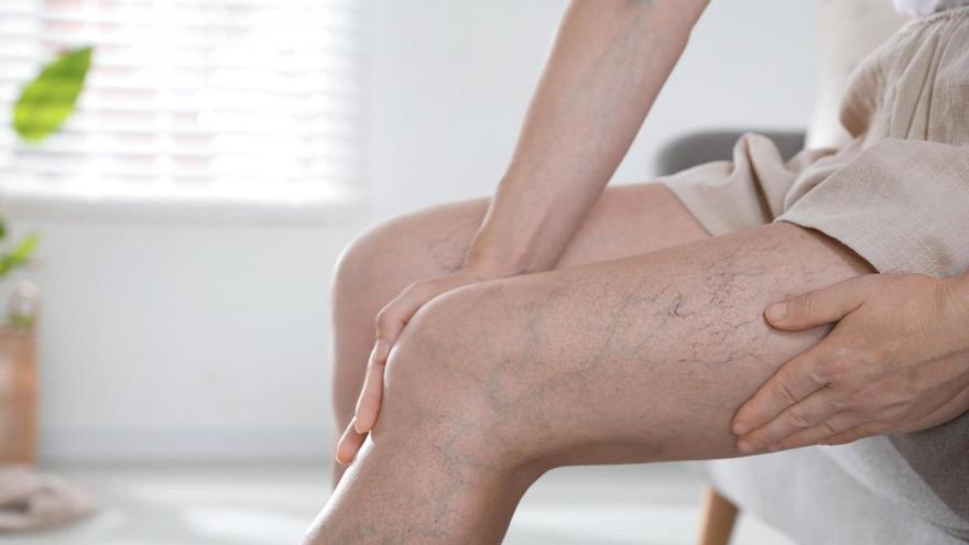 Las piernas hinchadas en verano no siempre son solo consecuencia del calor: cuándo conviene consultar a un especialista