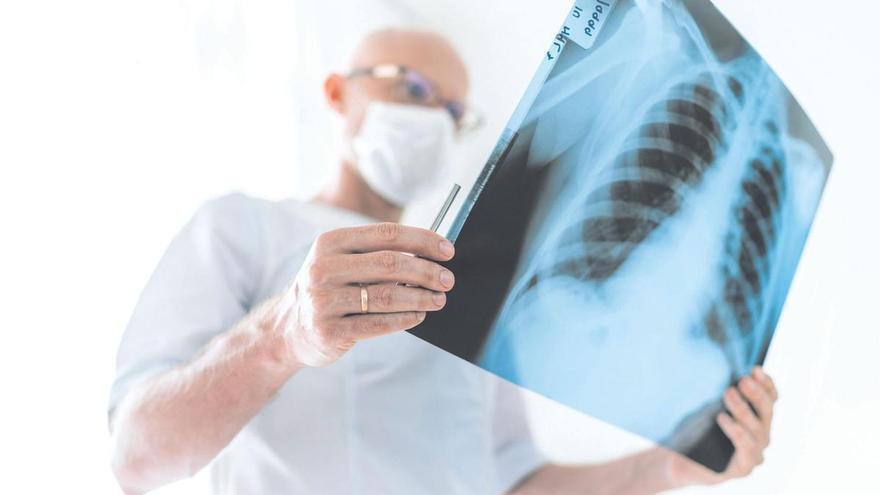 El Hospital de Alicante hará pruebas de TAC a fumadores para buscar cáncer de pulmón