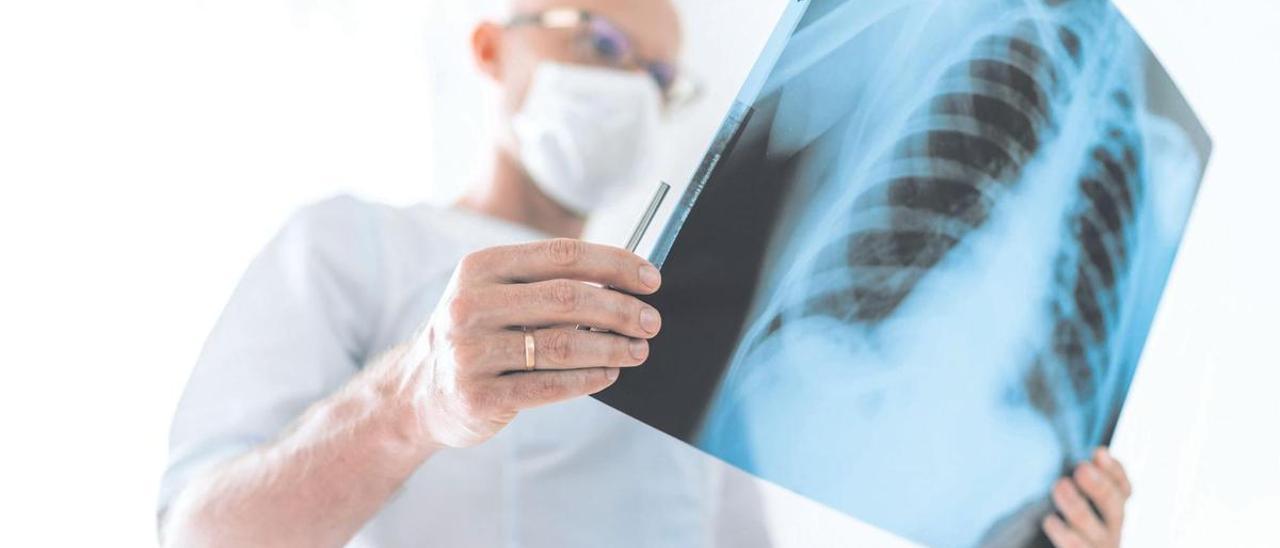 El cáncer de pulmón es el tercer tumor más diagnosticado en España.