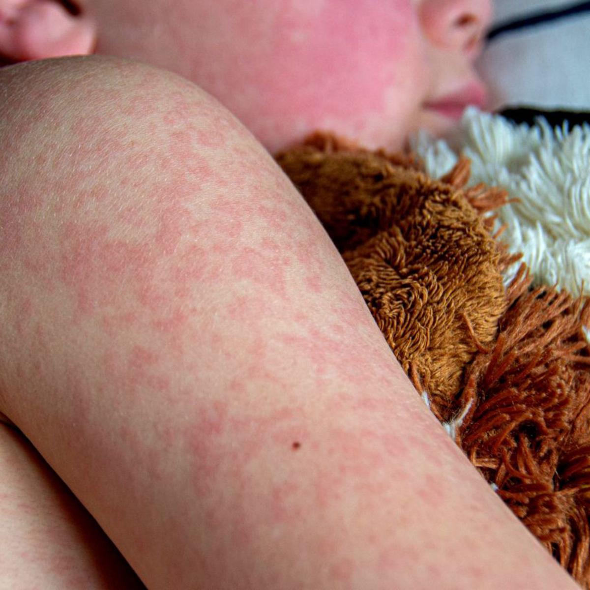 El xarampió ressorgeix a Espanya