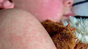 El xarampió ressorgeix a Espanya