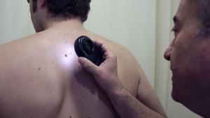 Un dermatólogo revisa los lunares de un paciente.