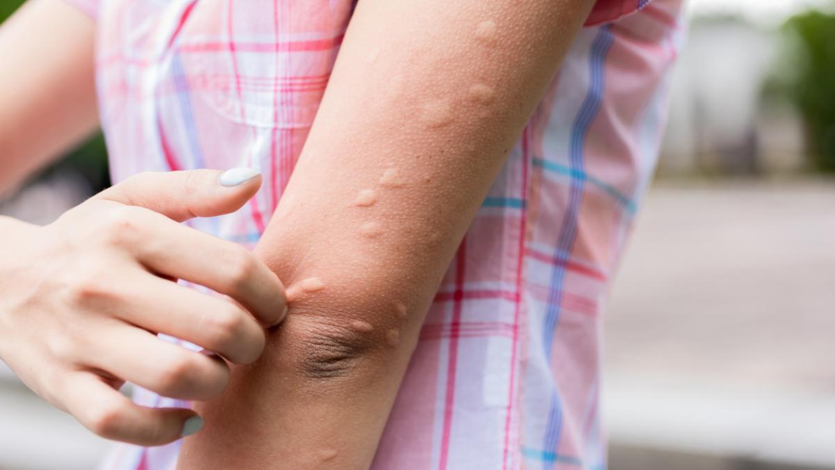 Las picaduras de mosquitos son una de las plagas del verano.