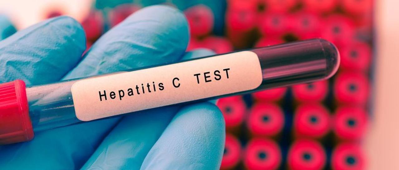 Resultado de una prueba de Hepatitis C. SHUTTERSTOCK