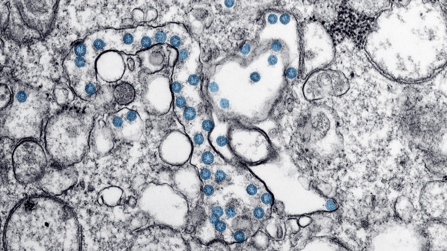 Imagen de microscopía electrónica de transmisión del primer caso de COVID-19 detectado en EEUU. Se observan las partículas esféricas virales, coloreadas en azul, colonizando orgánulos funcionales del citoplasma de una célula infectada.