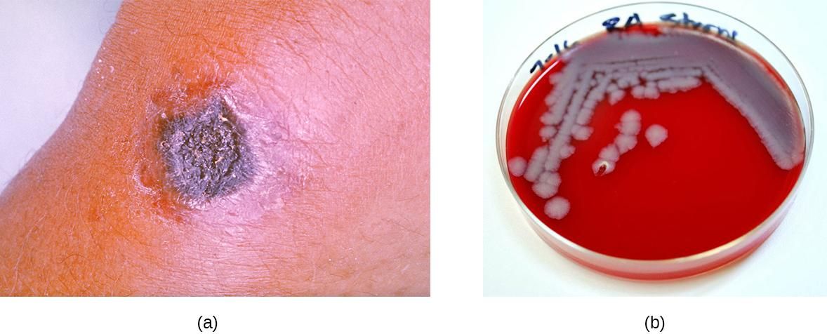 Herida de ántrax y cultivo con la bacteria que produce la enfermedad