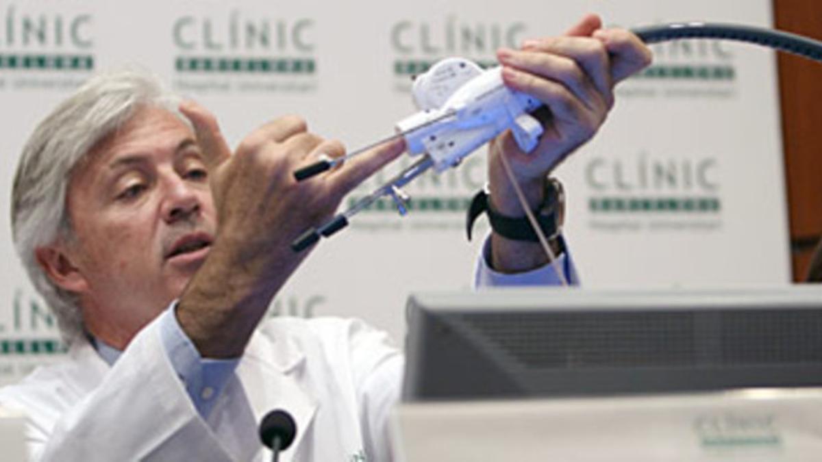 El doctor De Lacy, del Clínic, muestra el endoscopio que se introduce por la boca del paciente en la intervención.