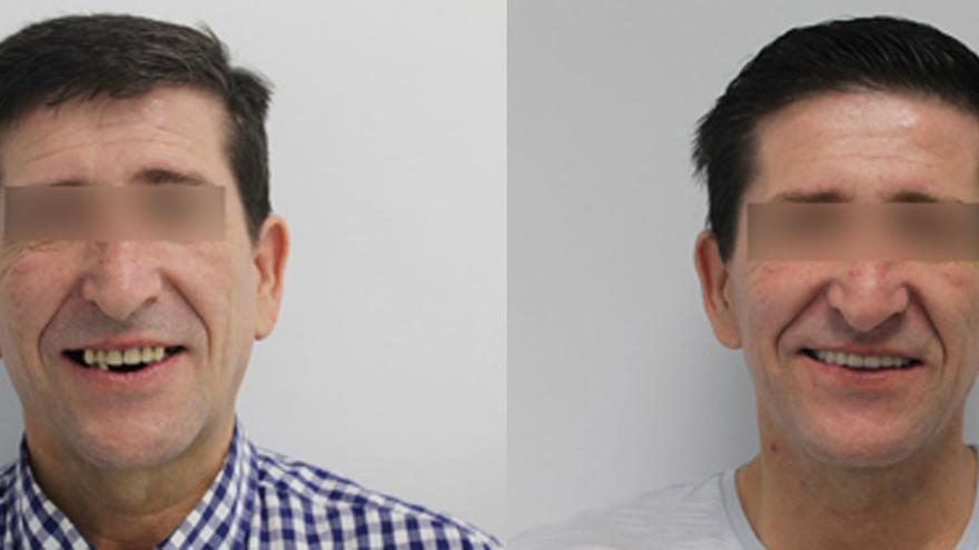 Un paciente, antes y después de la intervención en Naterabravo