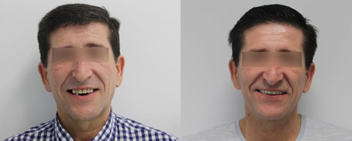 En Clínica Dental Náterabravo “Cambiamos su sonrisa en un solo día”