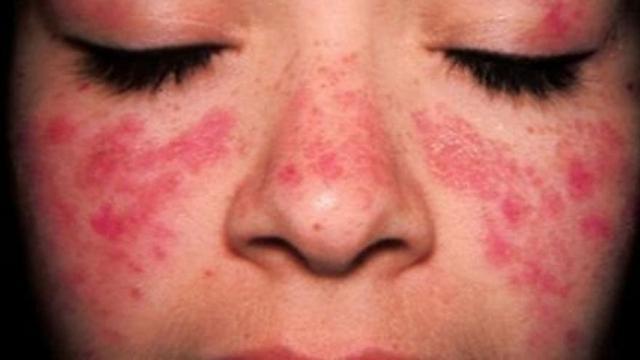 Imatge d’arxiu d’una dona que pateix lupus. | EUROPA PRESS